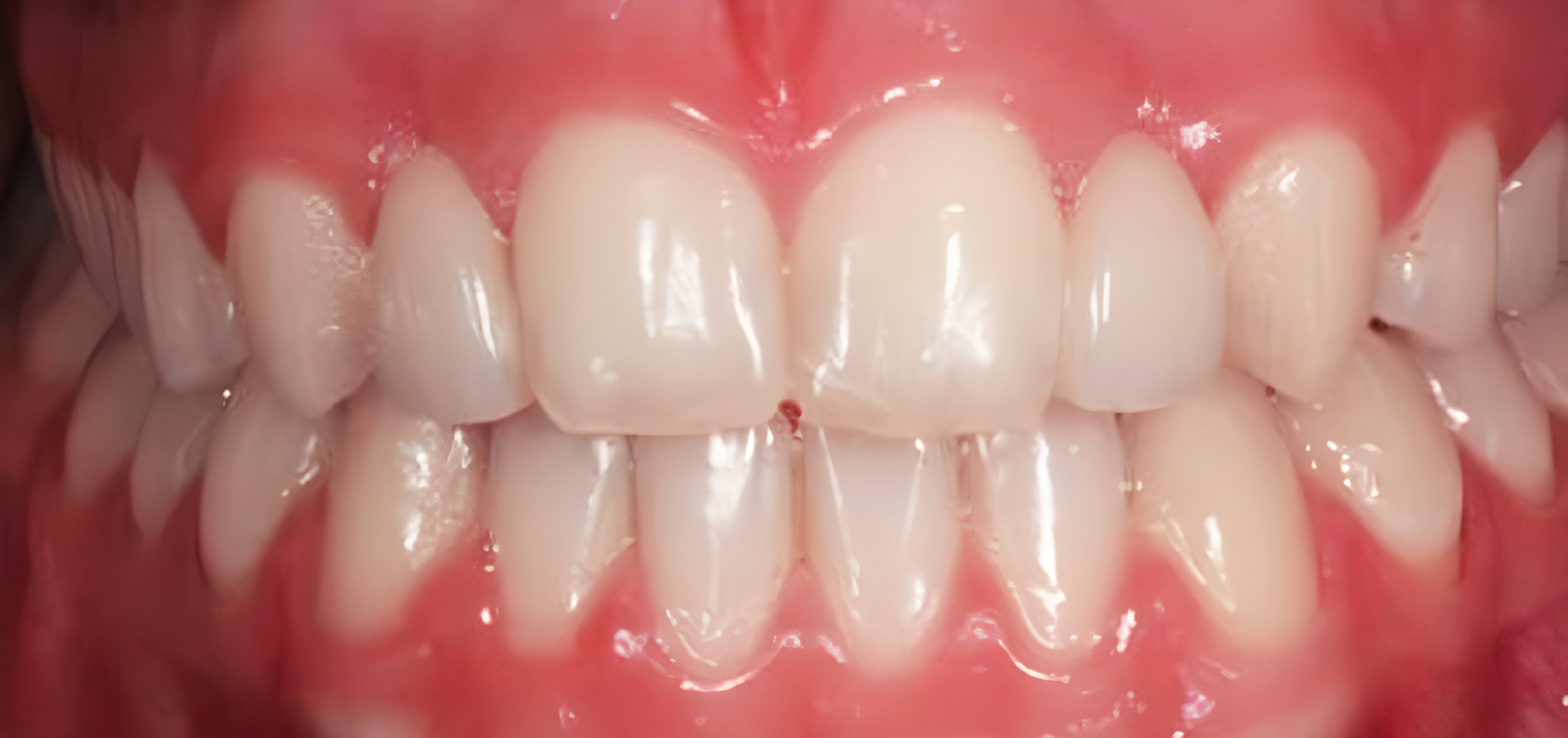 Finalizado tratamento- Ortodontia